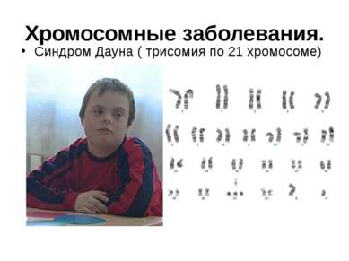 Хромосомные заболевания. Синдром Дауна ( трисомия по 21 хромосоме)