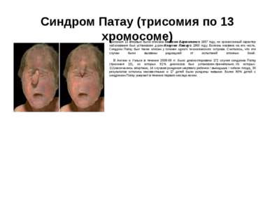 Синдром Патау (трисомия по 13 хромосоме) Трисомия 13 впервые была описана Том...