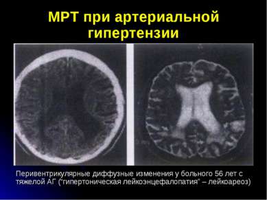 МРТ при артериальной гипертензии Перивентрикулярные диффузные изменения у бол...