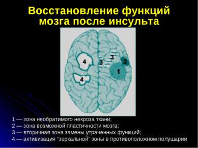 Восстановление функций мозга после инсульта 1 — зона необратимого некроза тка...