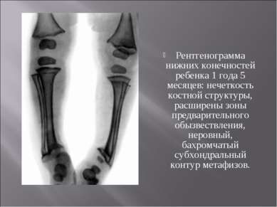 Рентгенограмма нижних конечностей ребенка 1 года 5 месяцев: нечеткость костно...