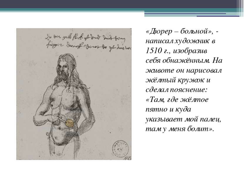 «Дюрер – больной», - написал художник в 1510 г., изобразив себя обнажённым. Н...