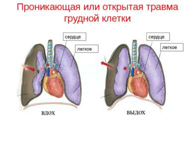 Проникающая или открытая травма грудной клетки сердце легкое легкое сердце
