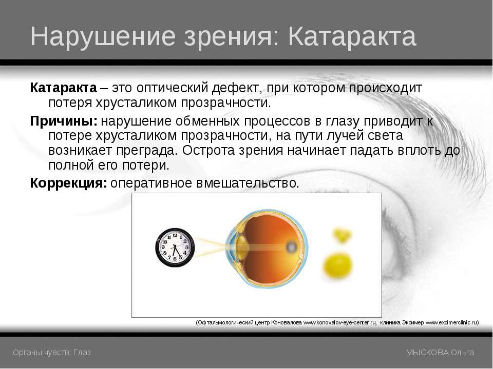 Причины заболевания зрения. Нарушение зрения катаракта. Нарушение прозрачности хрусталика. Катаракта презентация.