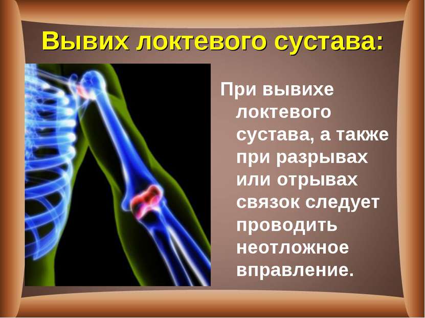 Вывих локтевого сустава: При вывихе локтевого сустава, а также при разрывах и...