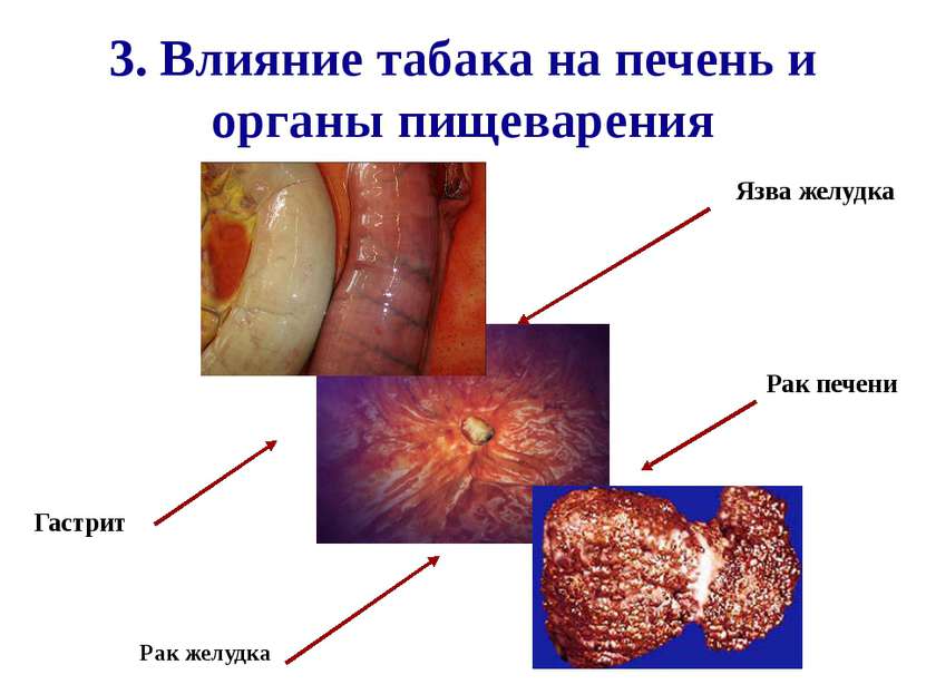 3. Влияние табака на печень и органы пищеварения Рак желудка Гастрит Рак пече...