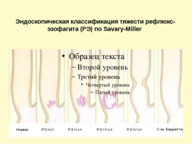 Эндоскопическая классификация тяжести рефлюкс-эзофагита (РЭ) по Savary-Miller 