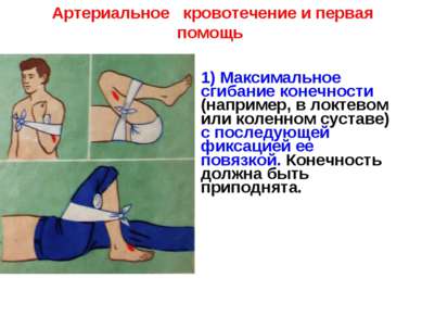 Артериальное кровотечение и первая помощь 1) Максимальное сгибание конечности...
