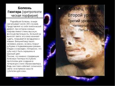 Болезнь Гюнтера (эритропоэтическая порфирия)       Редчайшая болезнь- в мире ...