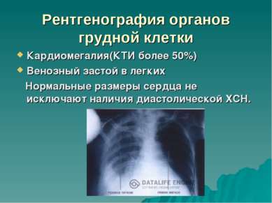 Рентгенография органов грудной клетки Кардиомегалия(КТИ более 50%) Венозный з...