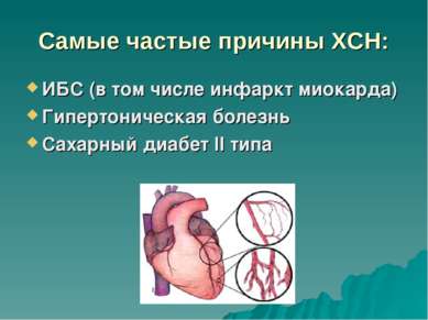 Самые частые причины ХСН: ИБС (в том числе инфаркт миокарда) Гипертоническая ...