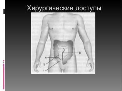 Хирургические доступы А-косой переменный (Мак-Бернея), Б-параректальный (Лена...