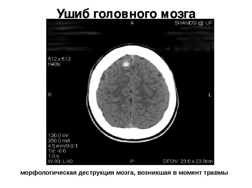 Ушиб головного мозга морфологическая деструкция мозга, возникшая в момент травмы