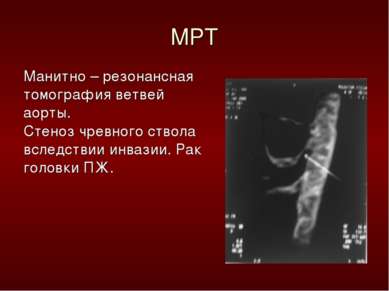 МРТ Манитно – резонансная томография ветвей аорты. Стеноз чревного ствола всл...