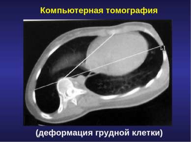 Компьютерная томография (деформация грудной клетки)