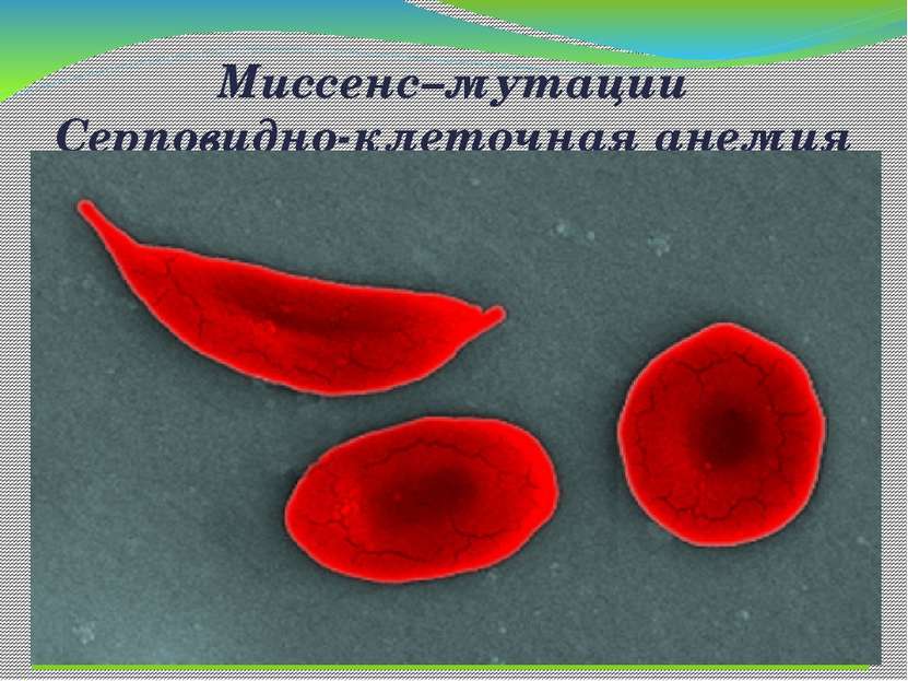 Миссенс–мутации Серповидно-клеточная анемия Замена всего лишь одного нуклеоти...