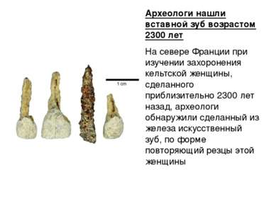 Археологи нашли вставной зуб возрастом 2300 лет На севере Франции при изучени...