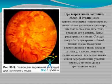 При выраженном застойном соске (II стадия) диск зрительного нерва гиперемиров...