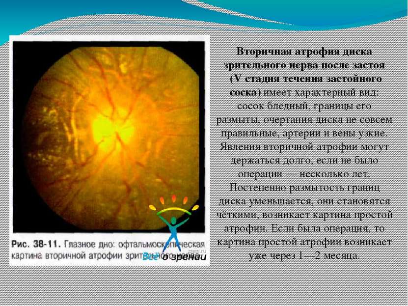 Вторичная атрофия диска зрительного нерва после застоя (V стадия течения заст...