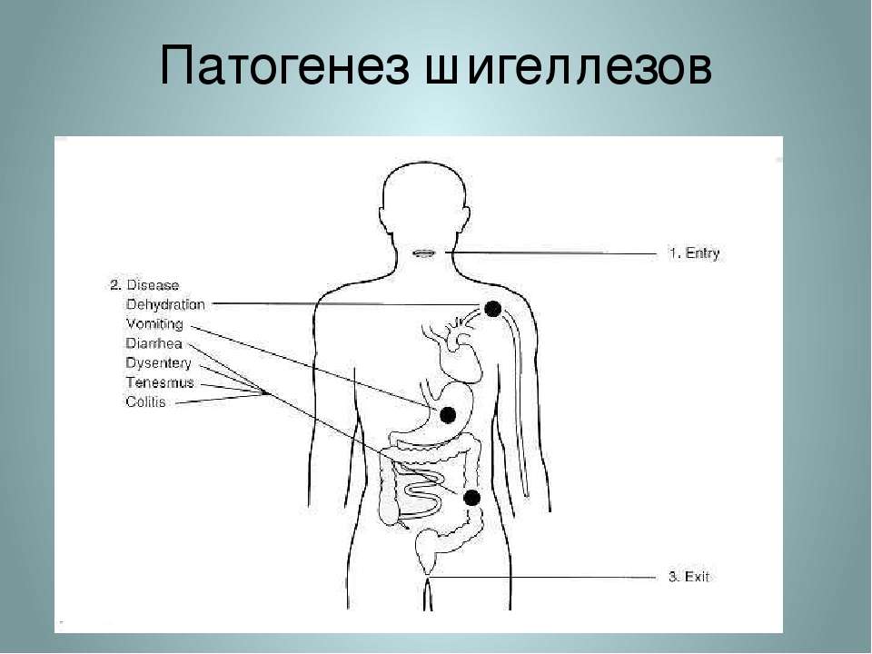 Патогенез дизентерии схема