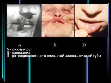А - кожный рог Б - папиллома В - ретенционная киста слизистой железы нижней г...