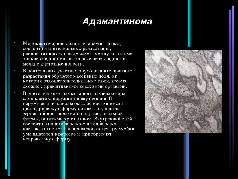 Адамантинома Монокистома, или солидная адамантинома, состоит из эпителиальных...