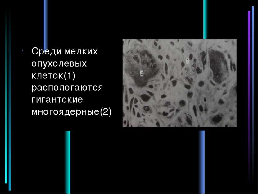 Среди мелких опухолевых клеток(1) распологаются гигантские многоядерные(2)