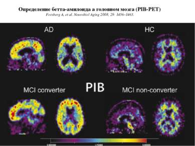 Определение бетта-амилоида а головном мозга (PIB-PET) Forsberg A, et al. Neur...