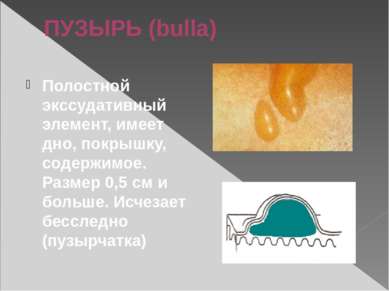 ПУЗЫРЬ (bulla) Полостной экссудативный элемент, имеет дно, покрышку, содержим...