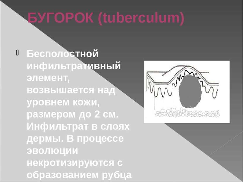 БУГОРОК (tuberculum) Бесполостной инфильтративный элемент, возвышается над ур...