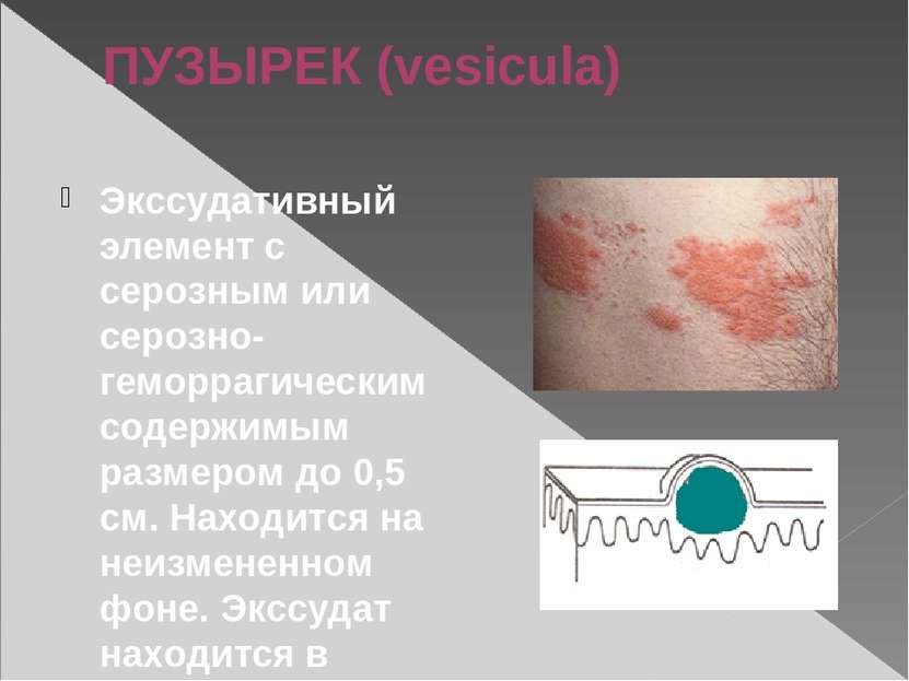 ПУЗЫРЕК (vesicula) Экссудативный элемент с серозным или серозно-геморрагическ...