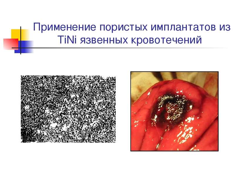 Применение пористых имплантатов из TiNi язвенных кровотечений