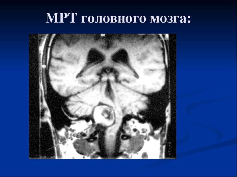 МРТ головного мозга: