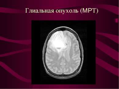 Глиальная опухоль (МРТ)