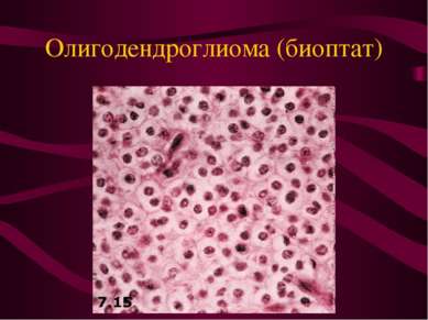 Олигодендроглиома (биоптат)