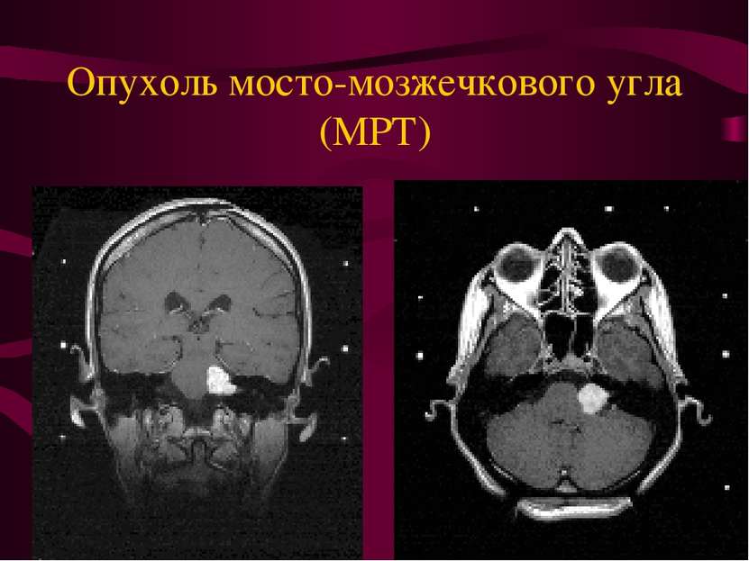Опухоль мосто-мозжечкового угла (МРТ)