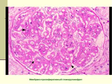 Мембрано-пролиферативный гломерулонефрит