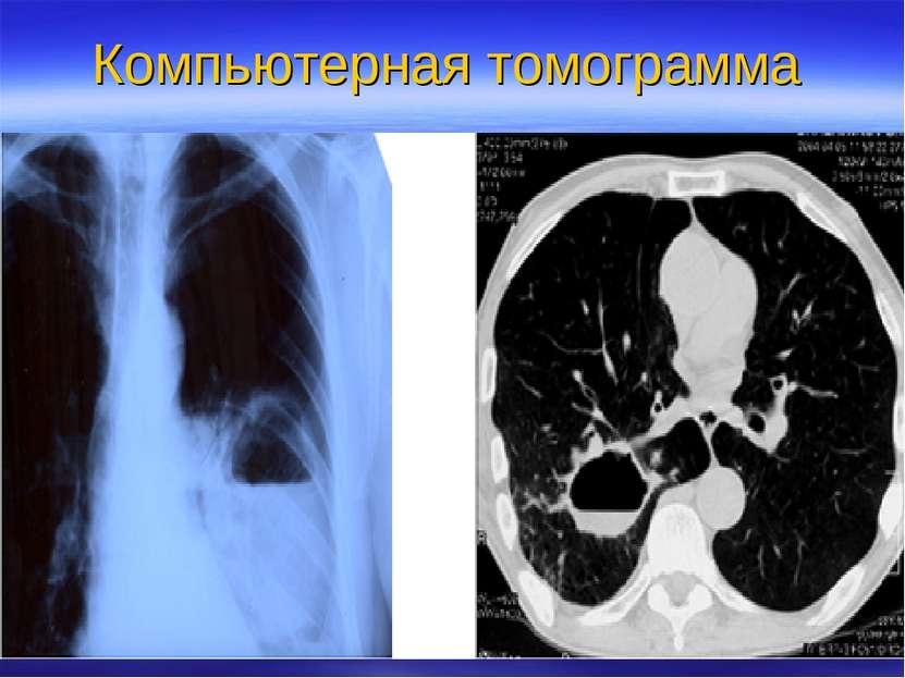 Компьютерная томограмма