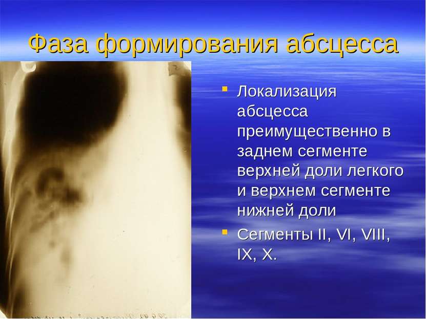 Фаза формирования абсцесса Локализация абсцесса преимущественно в заднем сегм...