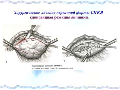 Хирургическое лечение первичной формы СПКЯ – клиновидная резекция яичников.