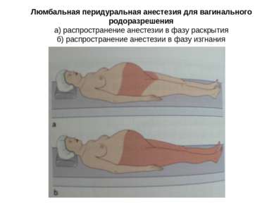 Люмбальная перидуральная анестезия для вагинального родоразрешения а) распрос...
