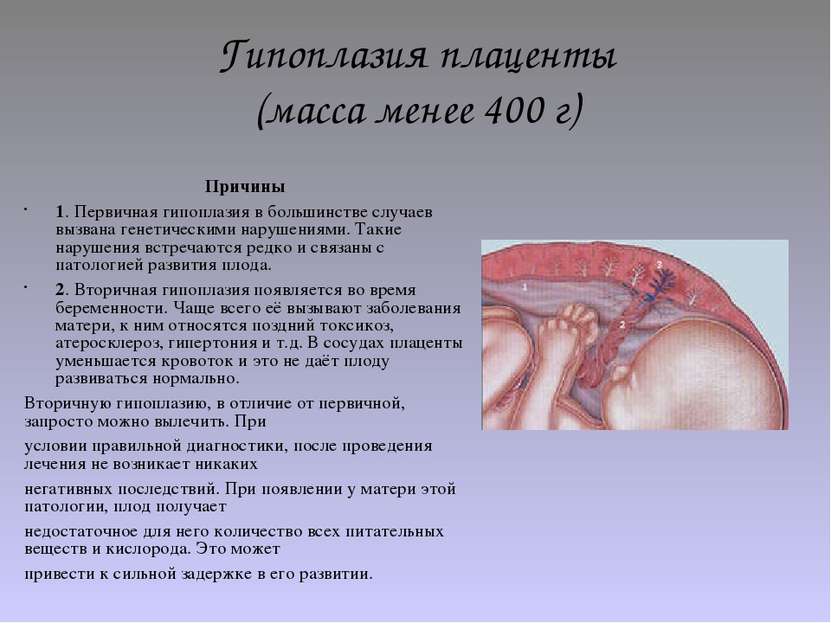 Гипоплазия плаценты (масса менее 400 г) Причины 1. Первичная гипоплазия в бол...