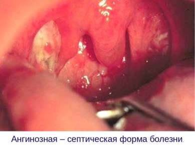 Ангинозная – септическая форма болезни.