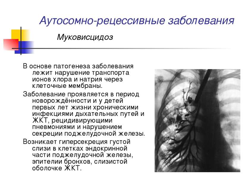 Аутосомно-рецессивные заболевания Муковисцидоз В основе патогенеза заболевани...