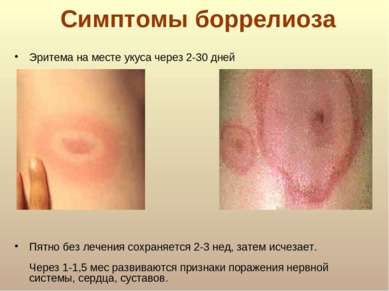 Симптомы боррелиоза Эритема на месте укуса через 2-30 дней Пятно без лечения ...