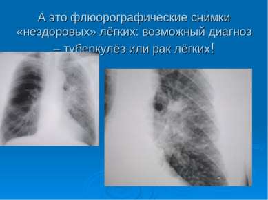 А это флюорографические снимки «нездоровых» лёгких: возможный диагноз – тубер...