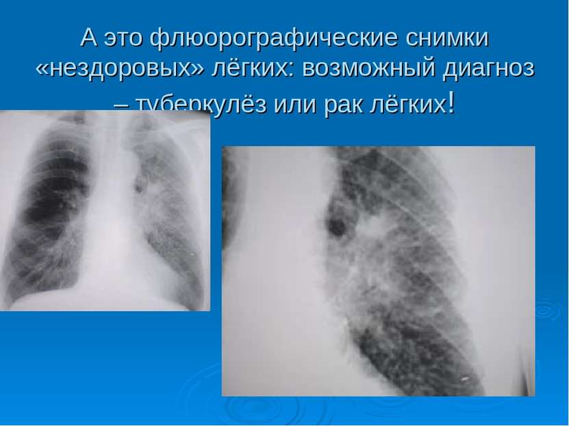 А это флюорографические снимки «нездоровых» лёгких: возможный диагноз – тубер...