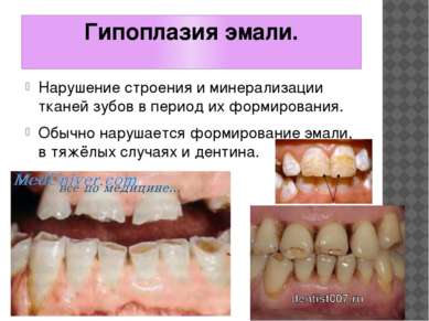 Гипоплазия эмали. Нарушение строения и минерализации тканей зубов в период их...