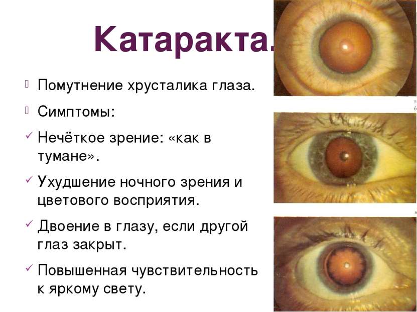 Катаракта. Помутнение хрусталика глаза. Симптомы: Нечёткое зрение: «как в тум...