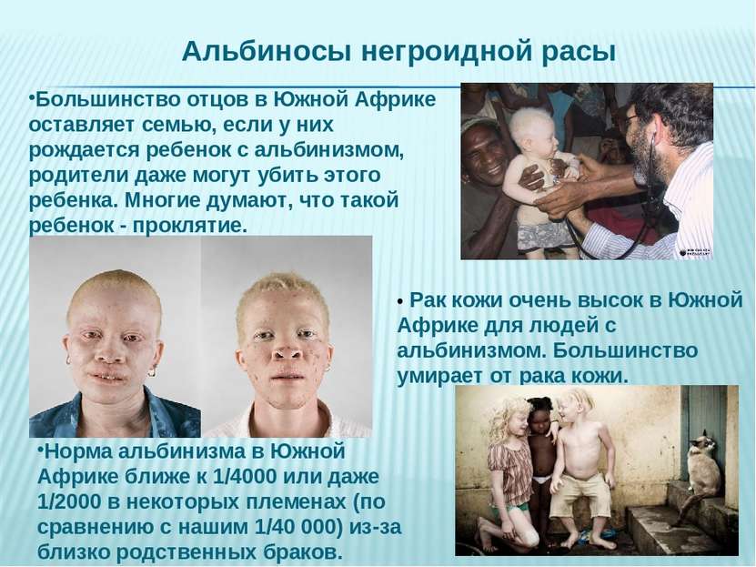 • Рак кожи очень высок в Южной Африке для людей с альбинизмом. Большинство ум...